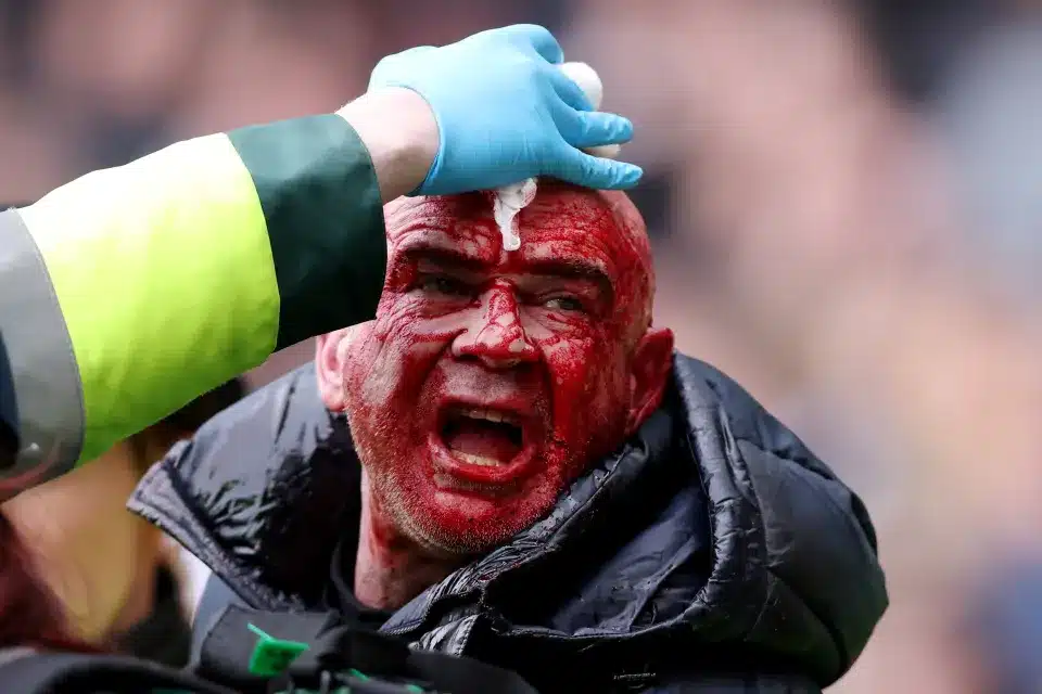 image-depicts-graphic-content-fan-875226985 FA CUP